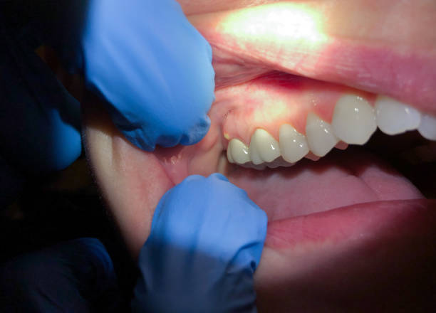Best Emergency Dentist for Lost Fillings or Crowns in New California, OH