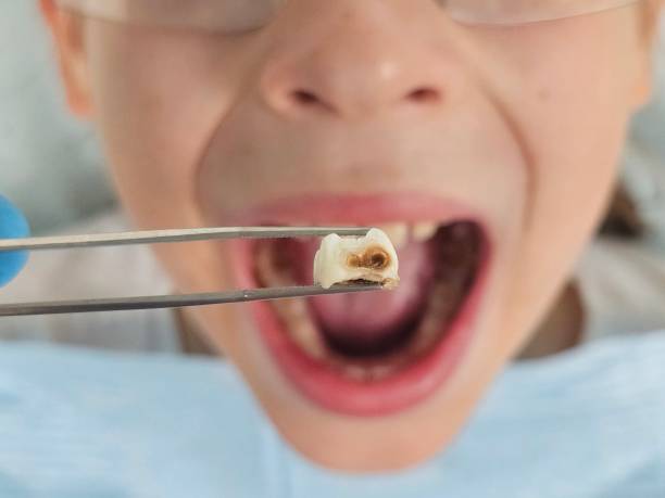 Best Emergency Dentist for Knocked-Out Tooth in New California, OH